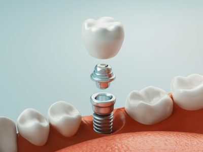 Dental care, dental implant, 3d rendering
